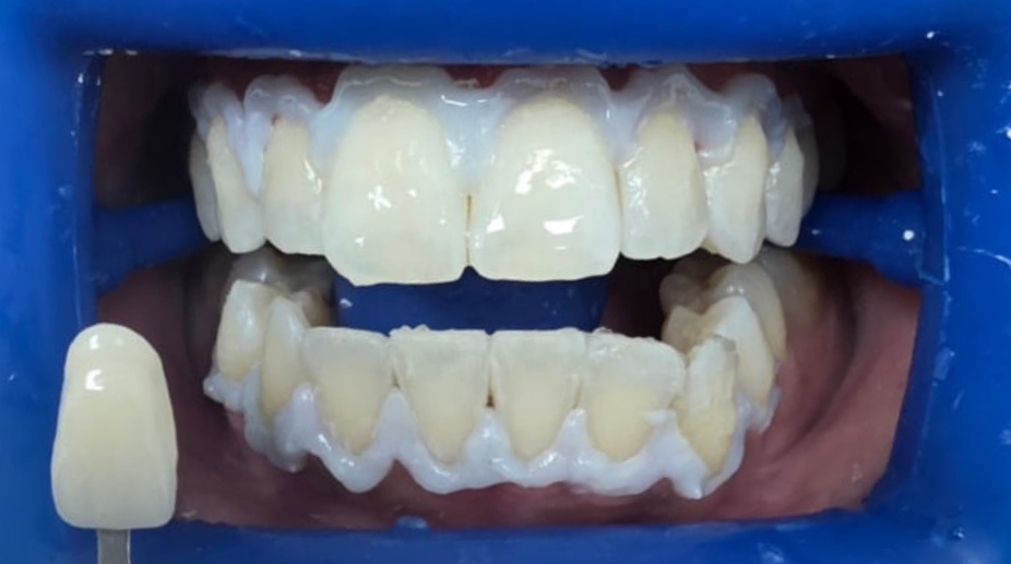 הלבנת שיניים אחרי - 1