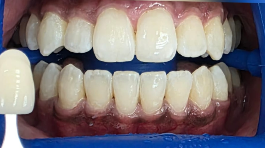 הלבנת שיניים אחרי - 2