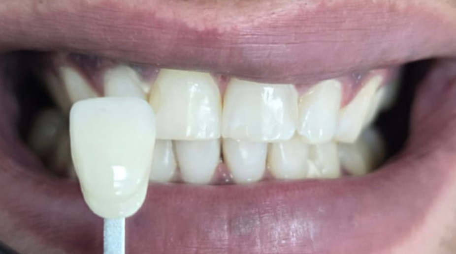 הלבנת שיניים אחרי - 3