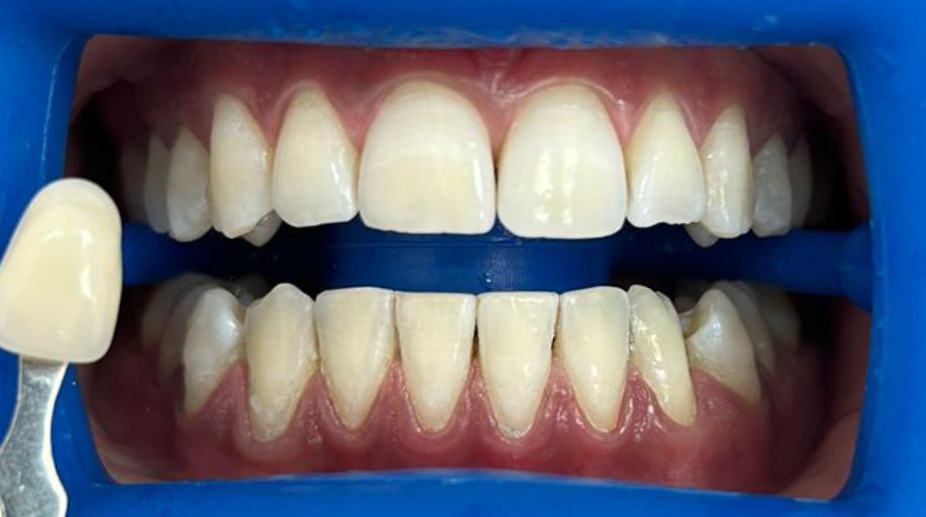 הלבנת שיניים אחרי - 4