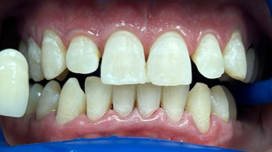 הלבנת שיניים אחרי - 5