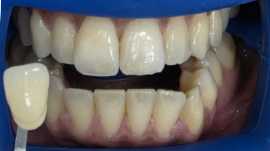 הלבנת שיניים לפני - 1