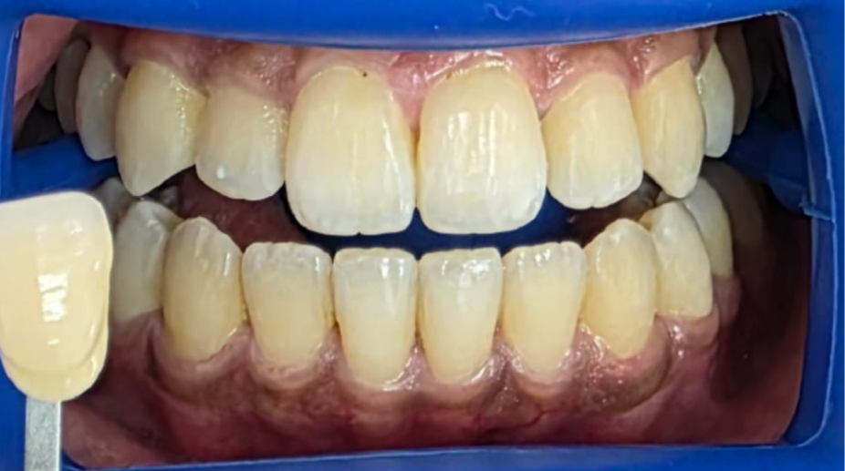 הלבנת שיניים לפני - 2