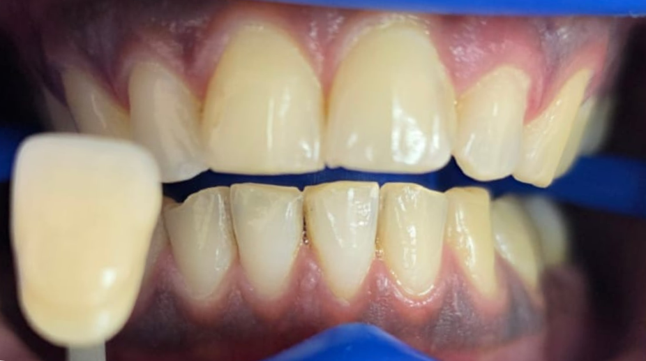 הלבנת שיניים לפני - 3