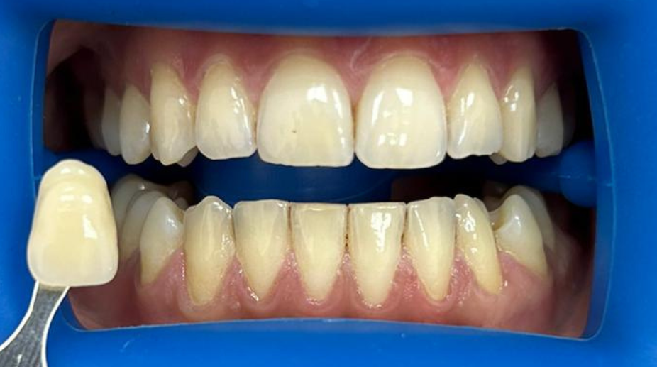 הלבנת שיניים לפני - 4