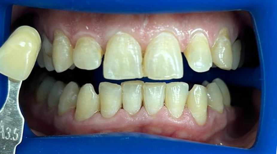 הלבנת שיניים לפני - 5