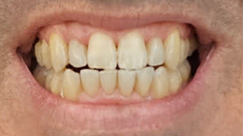 יישור שיניים אחרי - רמי