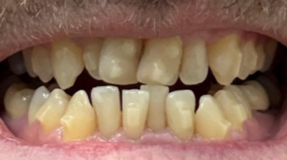 יישור שיניים לפני - לירז