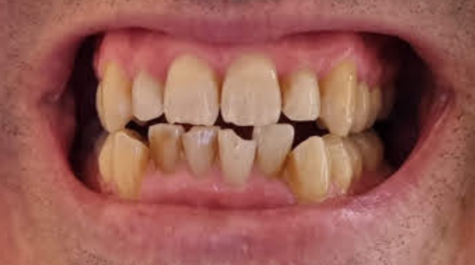 יישור שיניים לפני - רמי