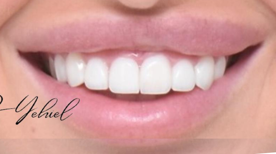 ציפויי שיניים אחרי - 1