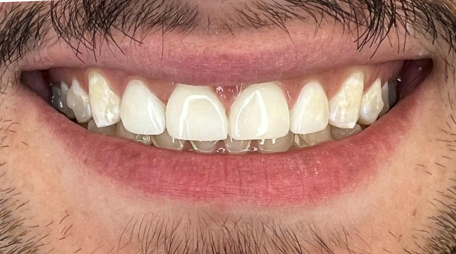 ציפויי שיניים אחרי - 2