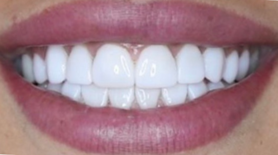 ציפויי שיניים אחרי - 3