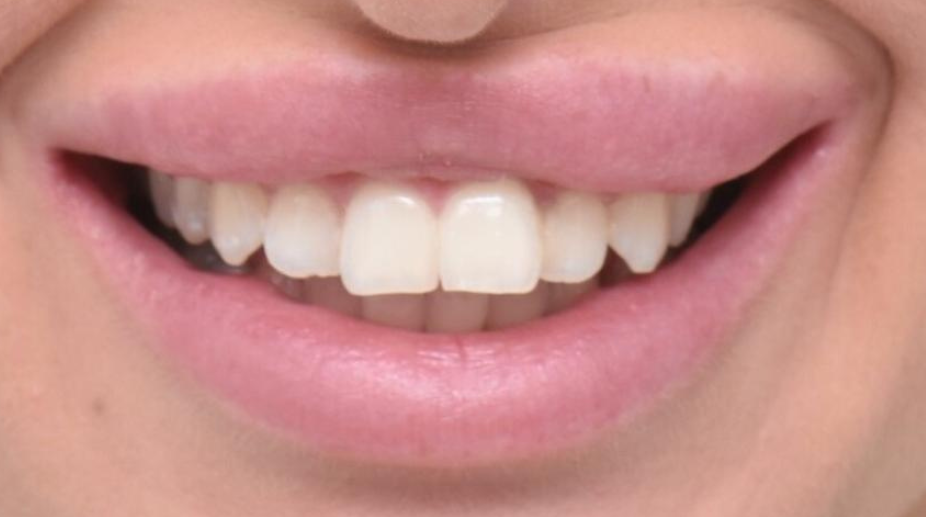 ציפויי שיניים לפני - 1 (1)