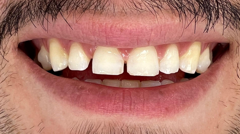 ציפויי שיניים לפני - 2