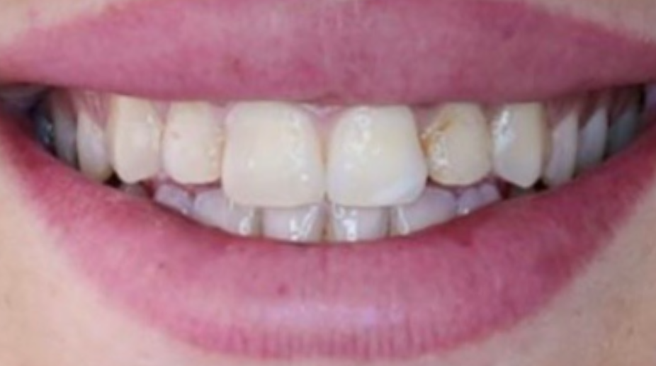 ציפויי שיניים לפני - 3